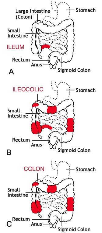 Crohn's Disease | Goodman & Bagamery